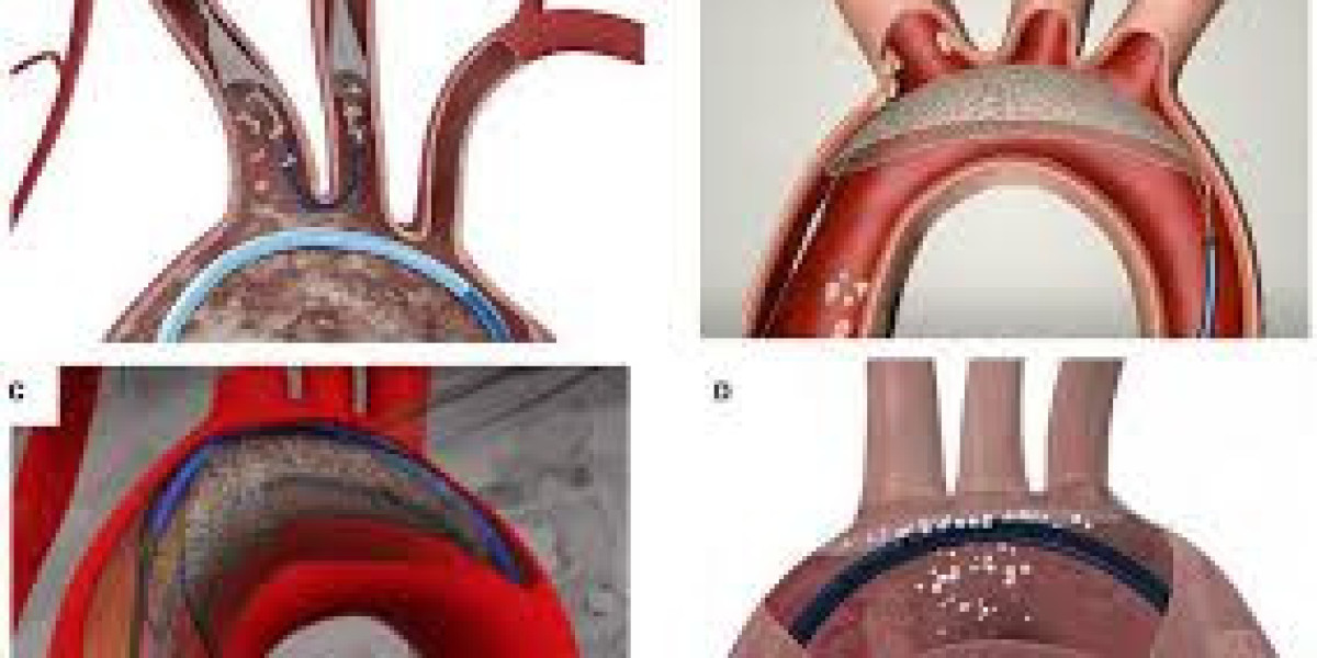 Embolic Protection Device Market Analysis Size And Forecast Report 2024-2032